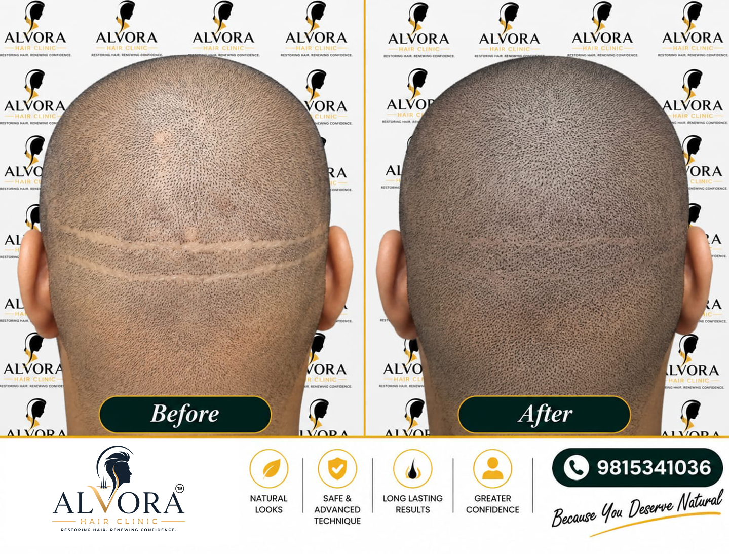 FUT-SMP-Before-after-results-by-Alvora-hair-Clinic