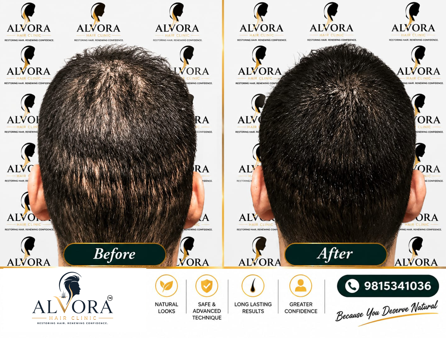 FUT-scar--SMP-Before-after-results-by-Alvora-hair-Clinic