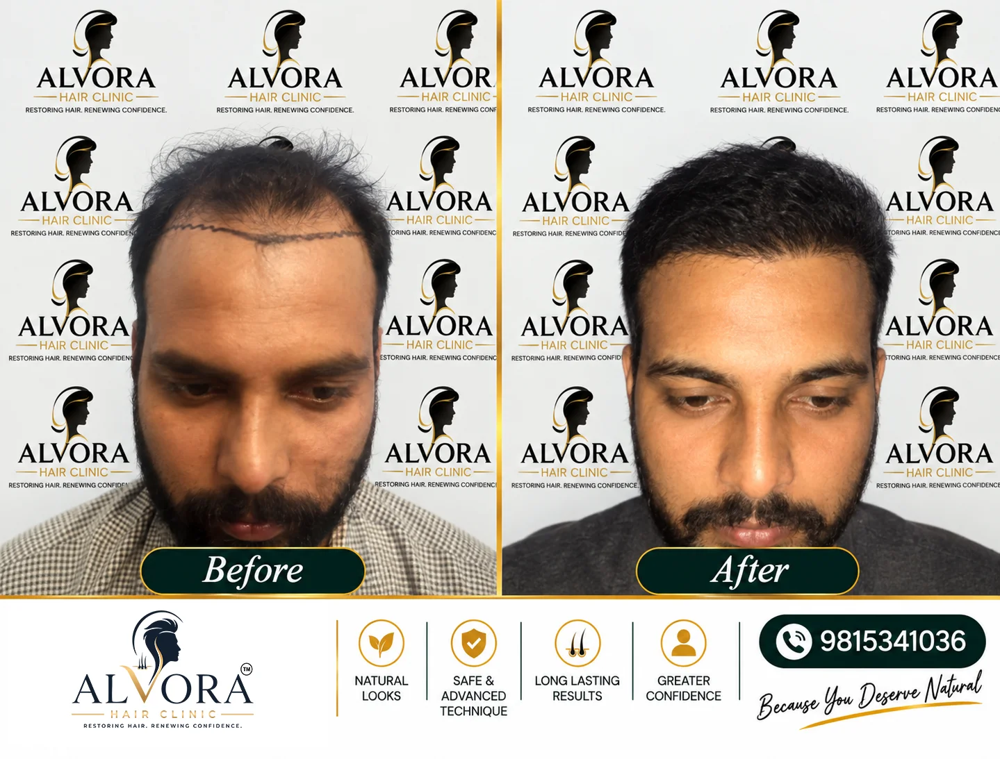 Hair Transplant in Ludhiana Before and After Result